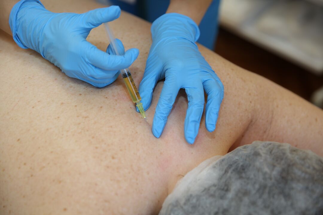 Ενέσεις χονδροπροστατευτικών για την πλάτη